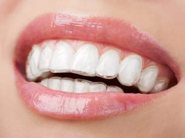 Clear-aligners